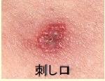 刺し口の画像